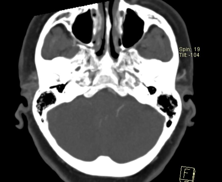File:Caroticocavernous fistula (Radiopaedia 29565-30069 Axial MIP 4).jpg