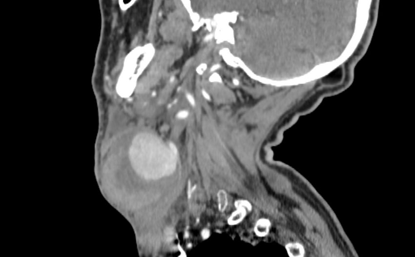 Carotid artery pseudoaneurysm (Radiopaedia 84030-99259 E 35).jpg