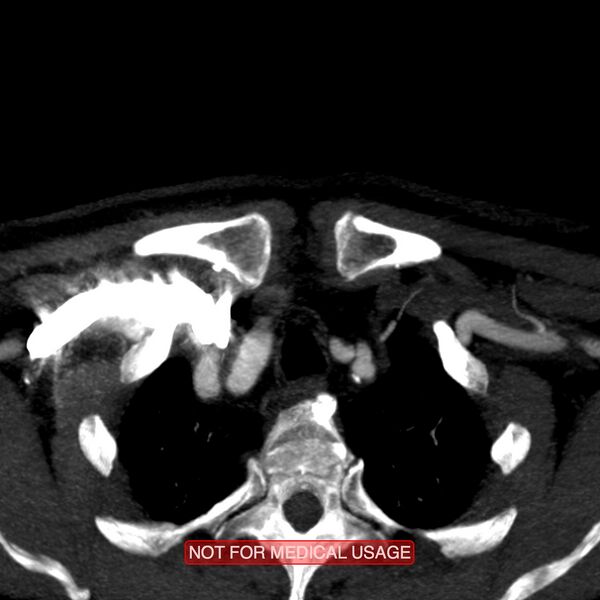 File:Carotid artery stenosis (Radiopaedia 28786-29086 C 27).jpg