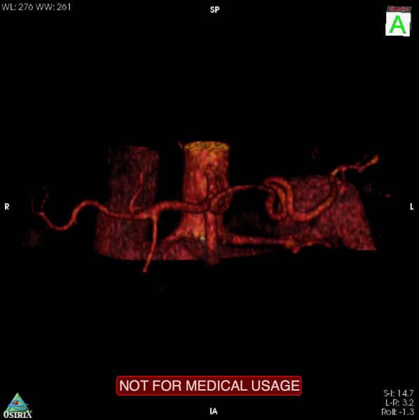 File:Celiac trunk variant anatomy - gastrohepatic trunk and splenic artery (Radiopaedia 38815-40995 B 9).jpg