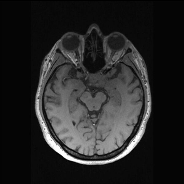 File:Central base of skull meningioma (Radiopaedia 53531-59549 Axial T1 23).jpg
