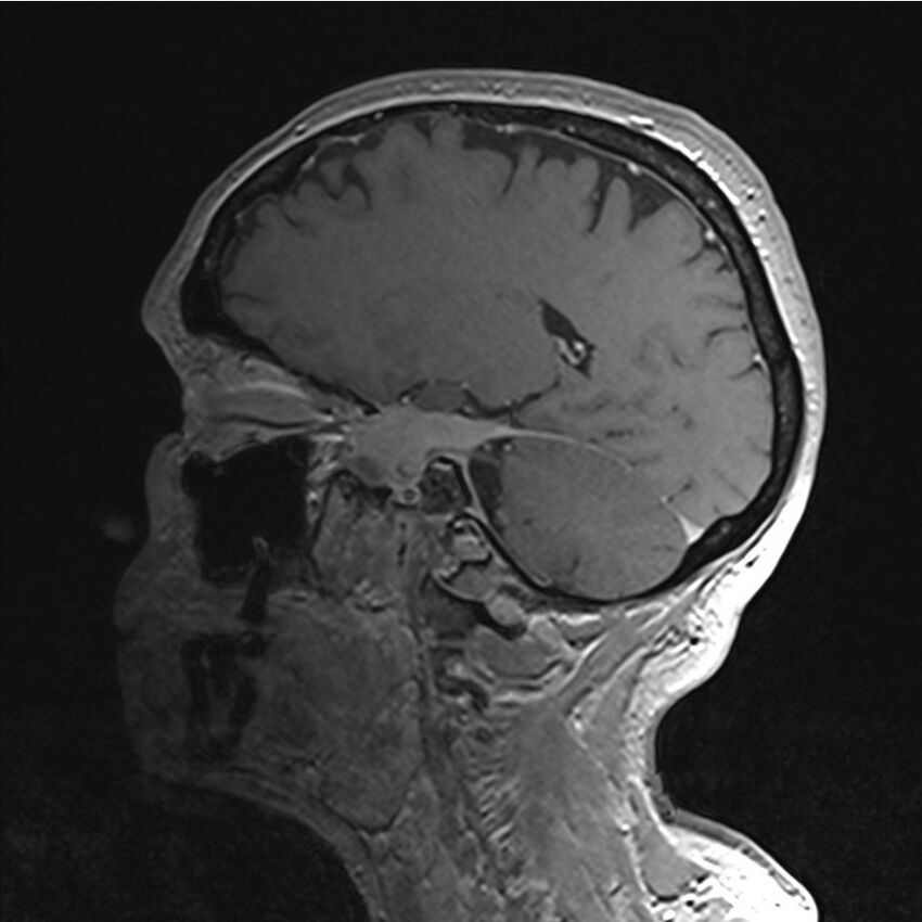 Central base of skull meningioma (Radiopaedia 53531-59549 Sagittal T1 C+ 45).jpg