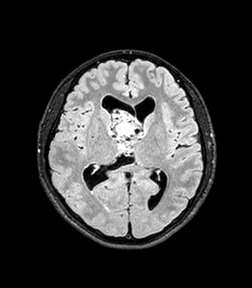 Central neurocytoma (Radiopaedia 79320-92380 Axial FLAIR 152).jpg