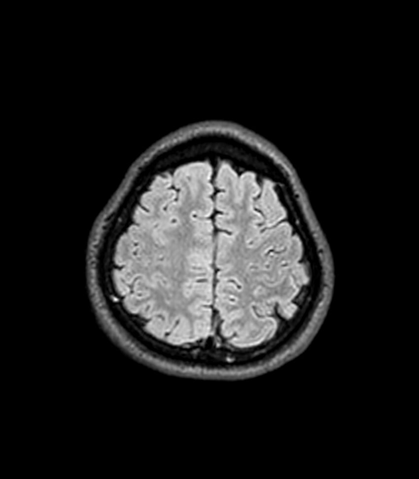 Central neurocytoma (Radiopaedia 79320-92380 Axial FLAIR 69).jpg