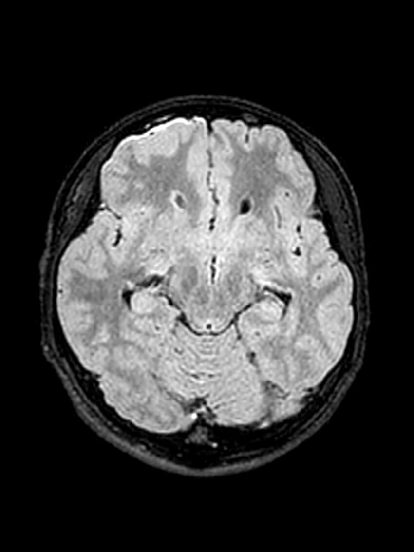 Central neurocytoma (Radiopaedia 79320-92381 Axial FLAIR 102).jpg