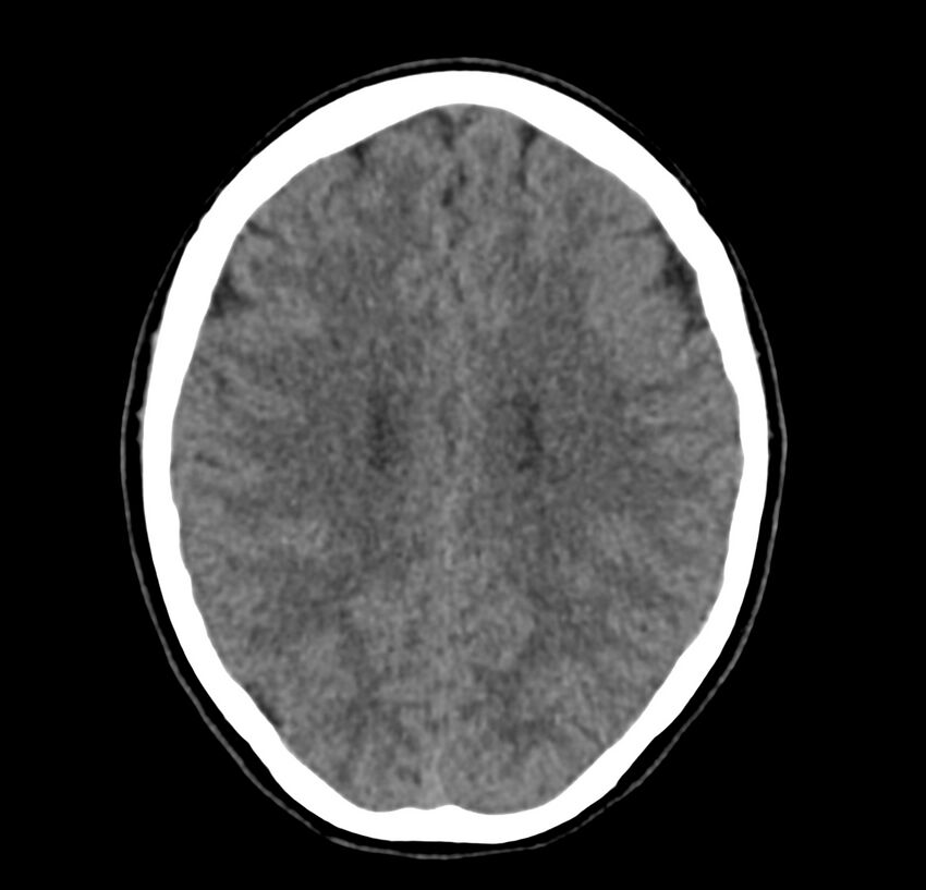 Cerebellar agenesis (Radiopaedia 30203-30817 Axial non-contrast 32).jpg