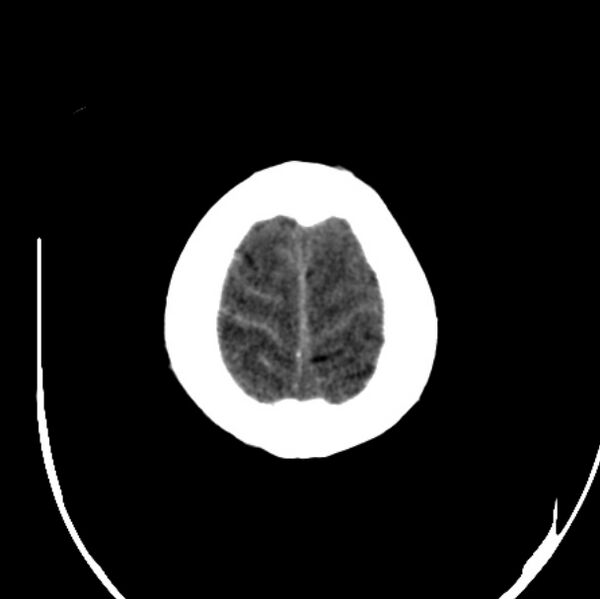 File:Cerebellar hemorrhage causing obstructive hydrocephalus (Radiopaedia 33989-35207 Axial non-contrast 48).jpg