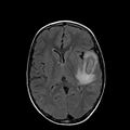 Cerebral abscess post cardiac surgery (Radiopaedia 27244-27420 Axial FLAIR 13).jpg