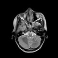 Cerebral abscess post cardiac surgery (Radiopaedia 27244-27420 Axial T2 5).jpg