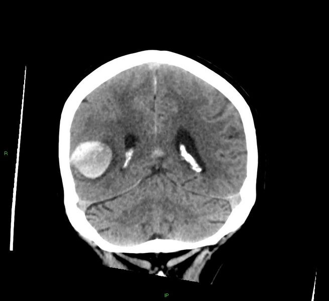 File:Cerebral amyloid angiopathy-associated lobar intracerebral hemorrhage (Radiopaedia 58378-65516 Coronal non-contrast 21).jpg