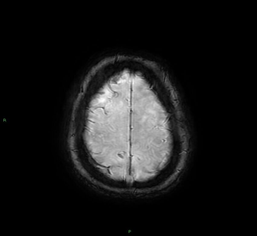 Cerebral amyloid angiopathy-associated lobar intracerebral hemorrhage (Radiopaedia 58378-65517 Axial SWI 63).jpg