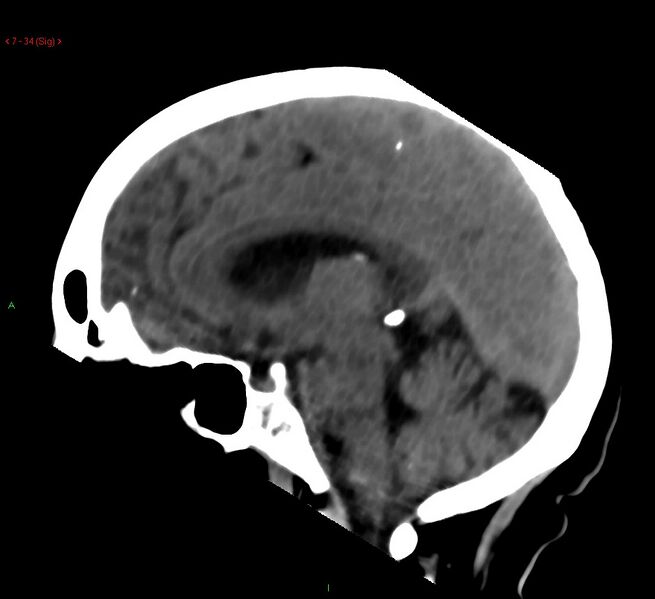 File:Cerebral amyloid angiopathy-associated lobar intracerebral hemorrhage (Radiopaedia 58378-65518 C 34).jpg