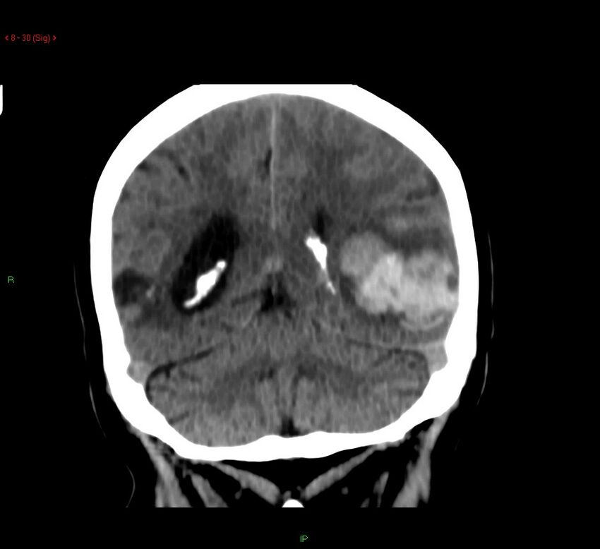 Cerebral amyloid angiopathy-associated lobar intracerebral hemorrhage (Radiopaedia 58378-65518 Coronal non-contrast 30).jpg