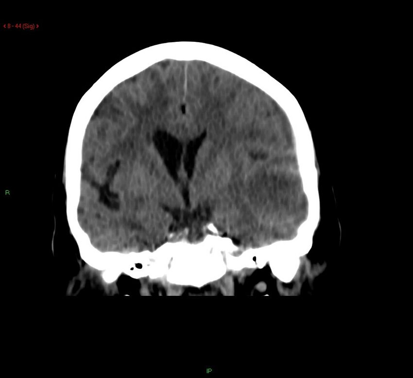 Cerebral amyloid angiopathy-associated lobar intracerebral hemorrhage (Radiopaedia 58378-65518 Coronal non-contrast 44).jpg
