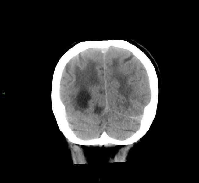 File:Cerebral amyloid angiopathy-associated lobar intracerebral hemorrhage (Radiopaedia 58561-65724 Coronal non-contrast 16).jpg