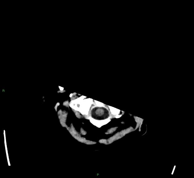 File:Cerebral amyloid angiopathy-associated lobar intracerebral hemorrhage (Radiopaedia 58563-65727 Axial non-contrast 52).jpg