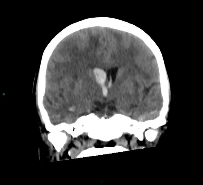 File:Cerebral amyloid angiopathy-associated lobar intracerebral hemorrhage (Radiopaedia 58566-65730 Coronal non-contrast 40).jpg