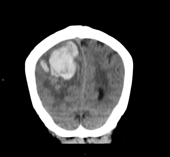 File:Cerebral amyloid angiopathy-associated lobar intracerebral hemorrhage (Radiopaedia 58751-65972 Coronal non-contrast 14).jpg