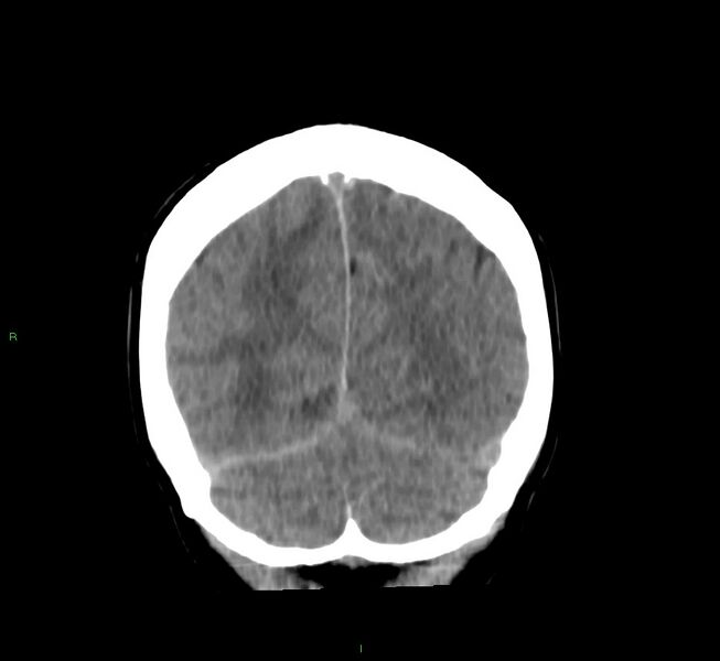File:Cerebral amyloid angiopathy-associated lobar intracerebral hemorrhage (Radiopaedia 58756-65977 Coronal non-contrast 18).jpg