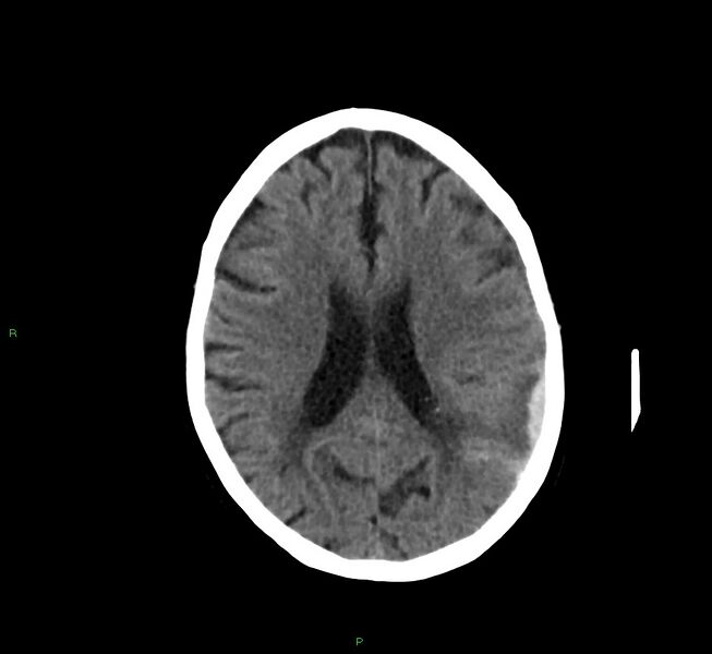 File:Cerebral amyloid angiopathy-associated lobar intracerebral hemorrhage (Radiopaedia 58757-65978 Axial non-contrast 22).jpg