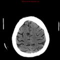 Cerebral and orbital tuberculomas (Radiopaedia 13308-13310 Axial non-contrast 23).jpg