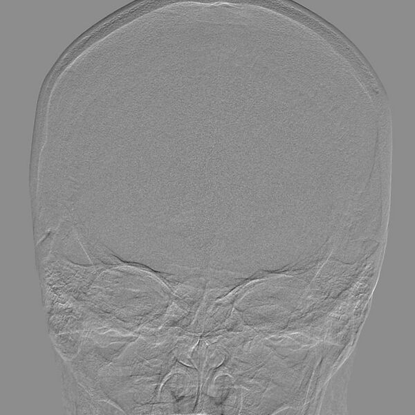 File:Cerebral aneurysm with rupture (Radiopaedia 29933-30458 LT CCA IC 7).jpg