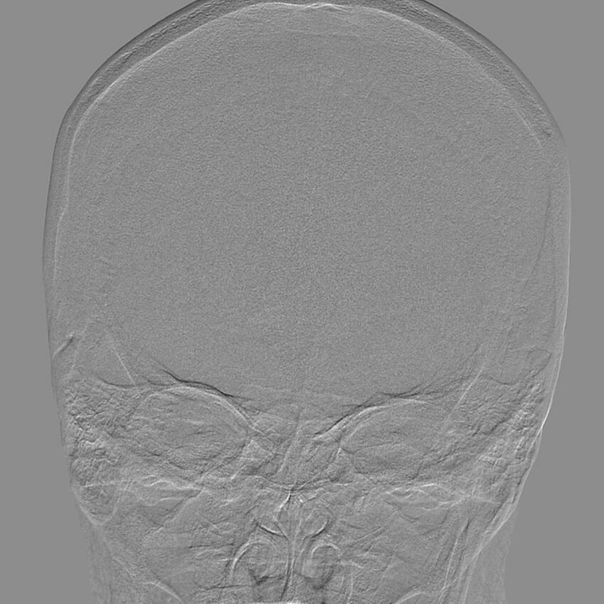 Cerebral aneurysm with rupture (Radiopaedia 29933-30458 LT CCA IC 7).jpg