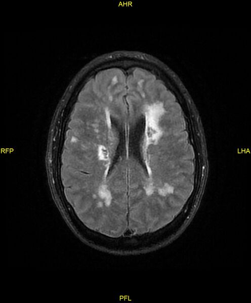 File:Cerebral autosomal dominant arteriopathy with subcortical infarcts and leukoencephalopathy (CADASIL) (Radiopaedia 86108-102054 Axial FLAIR 19).jpg