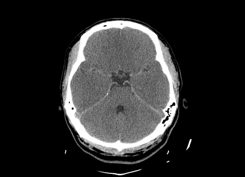 File:Cerebral edema (Radiopaedia 82519-96661 Axial non-contrast 37).jpg