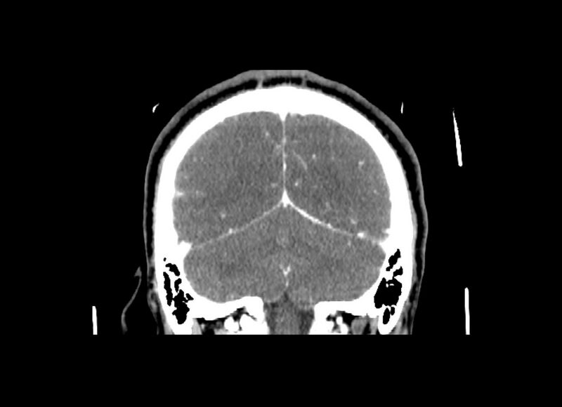 File:Cerebral edema (Radiopaedia 82519-96661 C 18).jpg