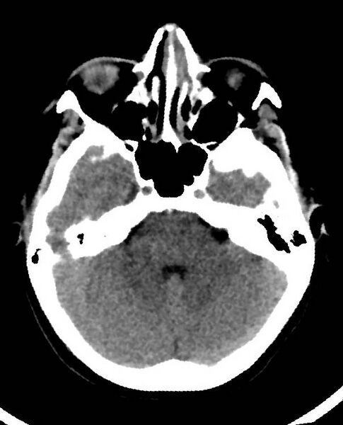 File:Cerebral edema due to severe hyponatremia (Radiopaedia 89826-106938 Axial non-contrast 30).jpg