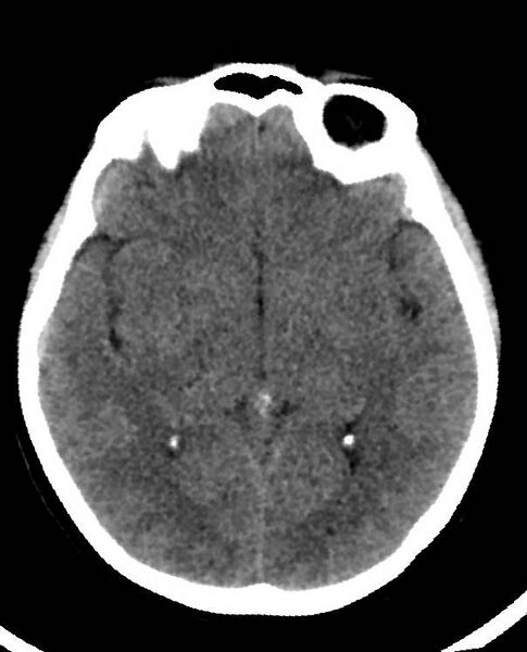 File:Cerebral edema due to severe hyponatremia (Radiopaedia 89826-106938 Axial non-contrast 49).jpg