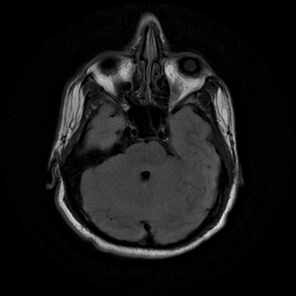 File:Cerebral fat embolism (Radiopaedia 37510-39363 Axial FLAIR 9).jpg
