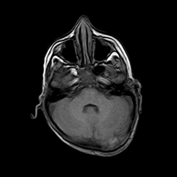 File:Cerebral tuberculoma (Radiopaedia 41152-43932 Axial T1 5).jpg