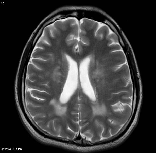 File:Cerebral vasculitis (Radiopaedia 5131-6923 Axial T2 6).jpg