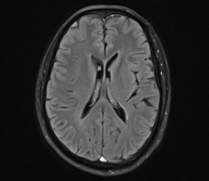 File:Cerebral venous thrombosis (Radiopaedia 71207-81504 Axial FLAIR 16).jpg