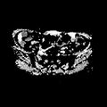Cervical carcinoma (Radiopaedia 78847-91705 Axial ADC 4).jpg