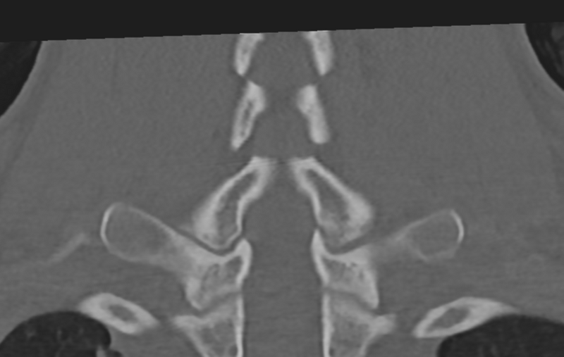 File:Cervical disc replacement (Radiopaedia 37383-39205 Coronal bone window 45).png