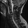 Cervical flexion teardrop fracture with cord hemorrhage (Radiopaedia 32497-33455 Sagittal T2 7).jpg