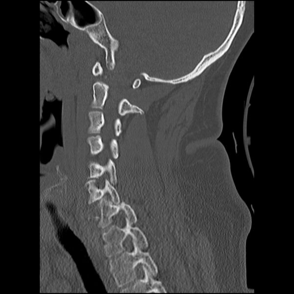 File:Cervical fracture and dislocation with locked facet (Radiopaedia 31837-32780 Sagittal bone window 11).jpg