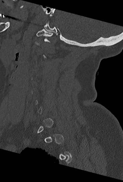 File:Cervical spine ACDF loosening (Radiopaedia 48998-54070 Sagittal bone window 27).png