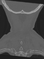 Cervical spondylolysis (Radiopaedia 49616-54811 Coronal bone window 57).png
