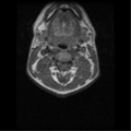 Cervical vertebrae metastasis (Radiopaedia 78814-91667 Axial T1 3).png