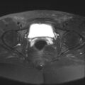 Cesarian section scar endometriosis (Radiopaedia 66520-75799 Axial T2 fat sat 20).jpg