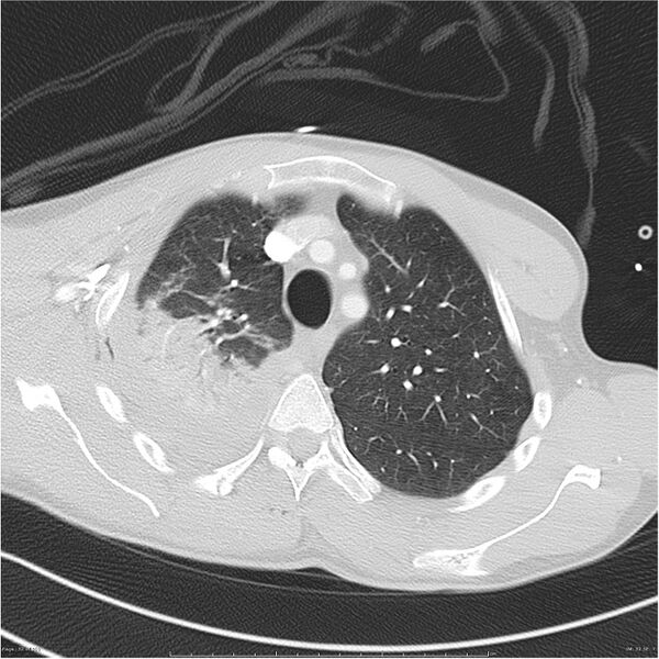 File:Chest and abdomen multi-trauma (Radiopaedia 26294-26425 lung window 32).jpg