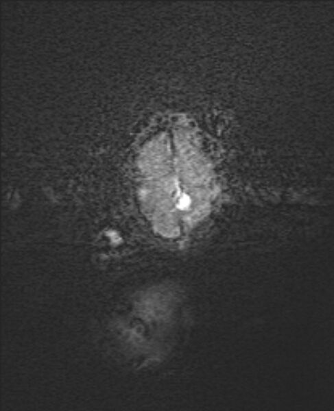File:Chiari III malformation with occipital encephalocele (Radiopaedia 79446-92559 Axial SWI 1).jpg
