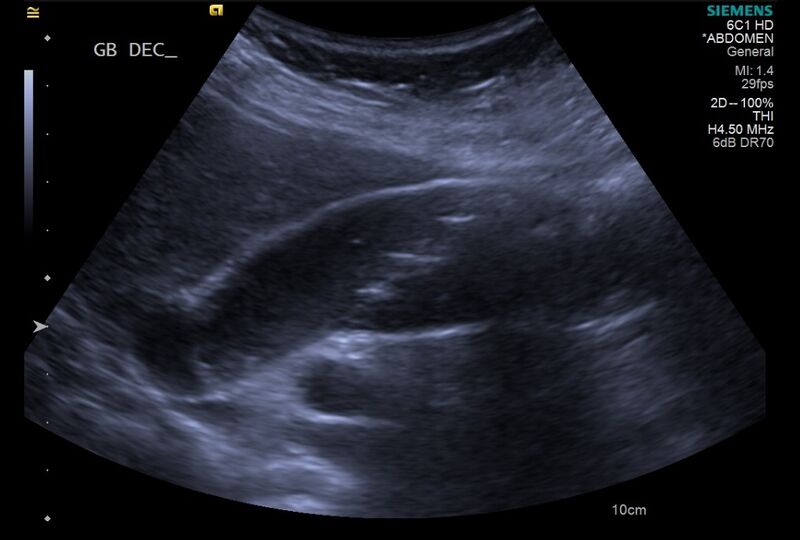 File:Cholelithiasis with biliary dilatation (Radiopaedia 49442-54588 A 15).jpg