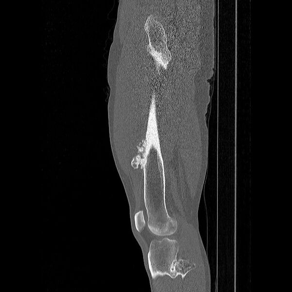 File:Chondrosarcoma arising from exostosis (Radiopaedia 59996-67507 Sagittal bone window 3).jpg