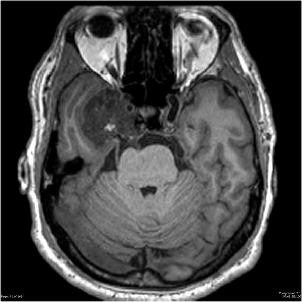 File:Chondrosarcoma of skull base- grade II (Radiopaedia 40948-43654 Axial T1 41).jpg