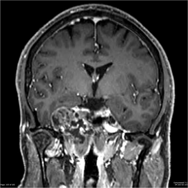 File:Chondrosarcoma of skull base- grade II (Radiopaedia 40948-43654 Coronal T1 C+ 14).jpg